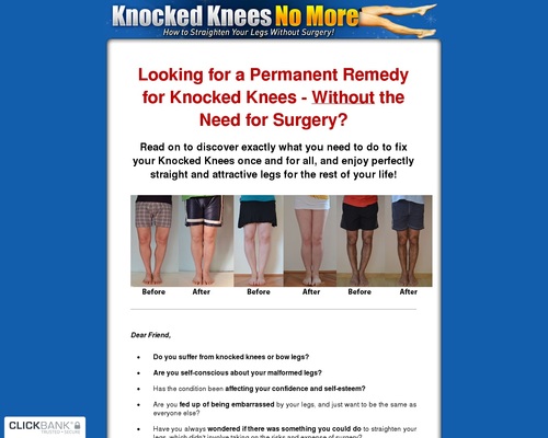 Knocked Knees No More - How to Straighten Your Legs Without Surgery!