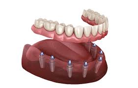 Full Teeth Implants All-on-4 or All-on-6